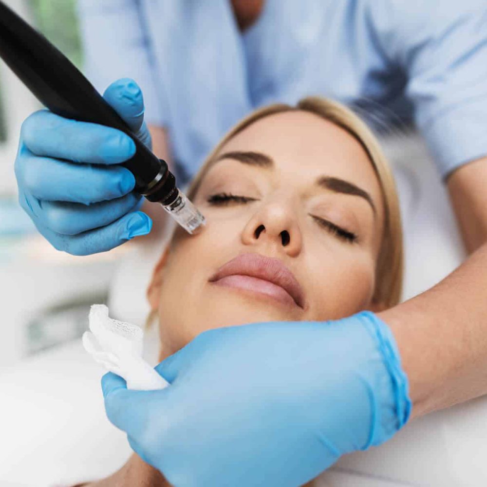 micro-needling2